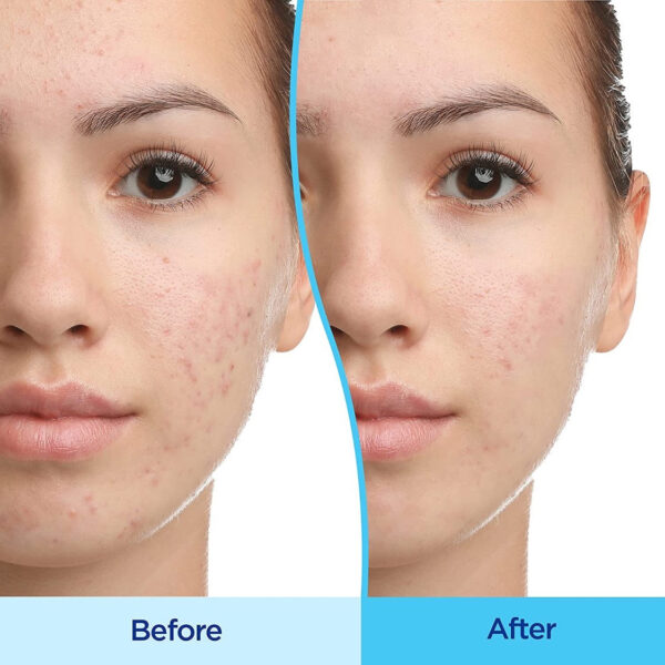 Gel Differin Adapalene Tratamiento Antiacné 0.1% Tipo de piel Sensible, Acneica - Image 9