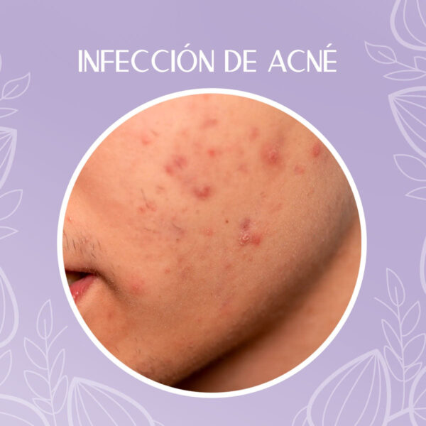 Crema Despigmentante Para Manchas, Melasma, Acné Y Paño - Image 4