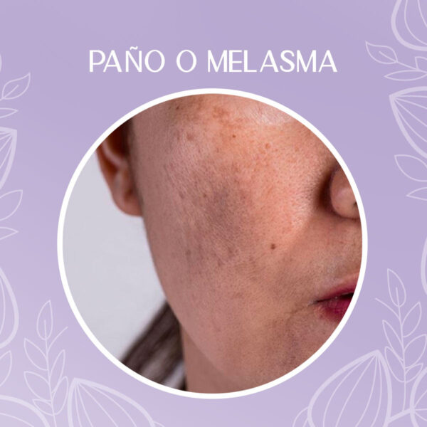 Crema Despigmentante Para Manchas, Melasma, Acné Y Paño - Image 7